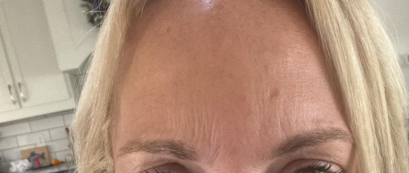 Smooth forehead after Botox treatment