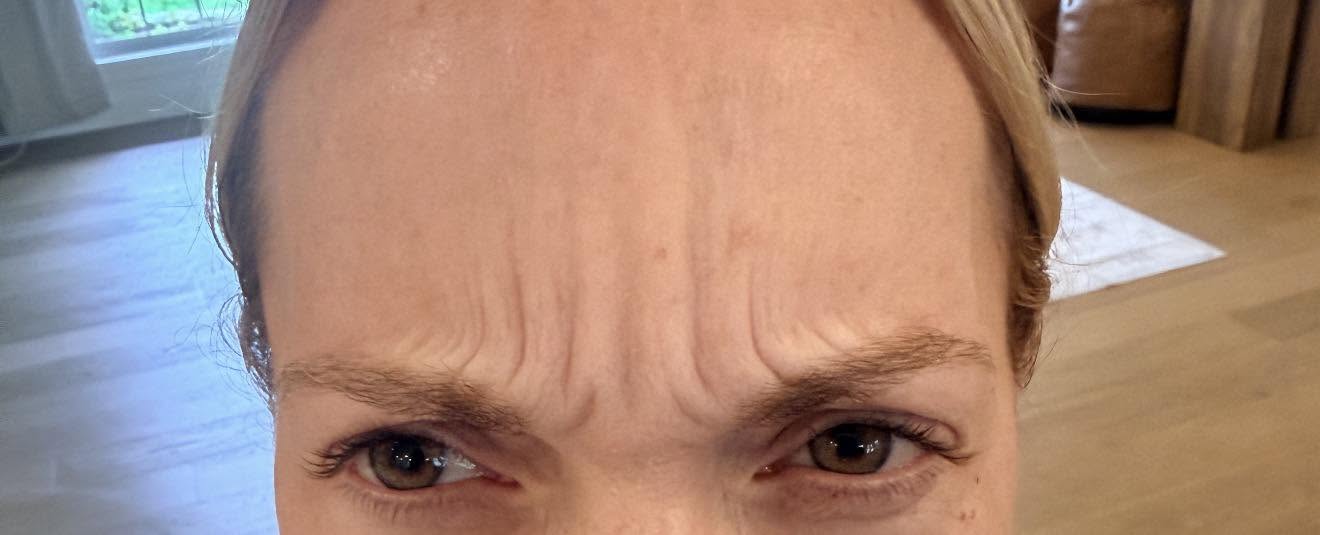 Frown lines before Botox treatment