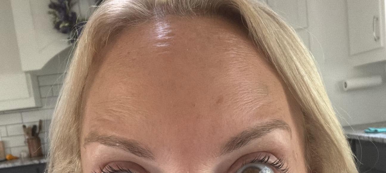 Forehead lines after treatment