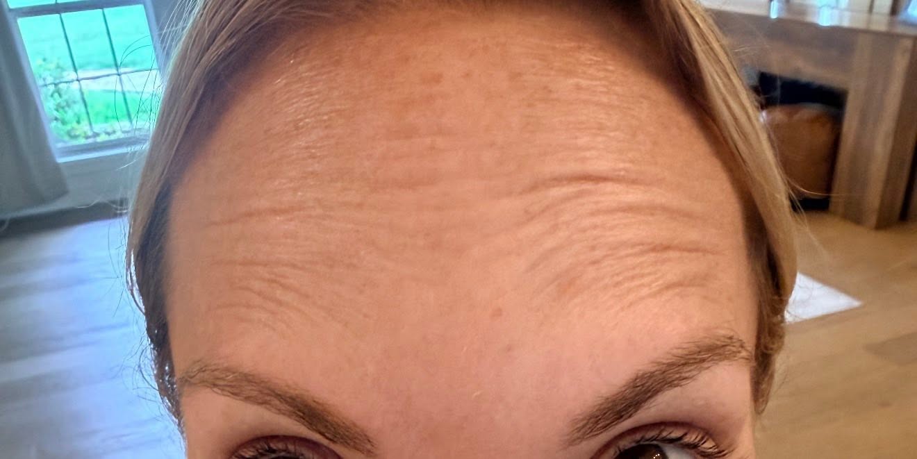 Forehead lines before treatment