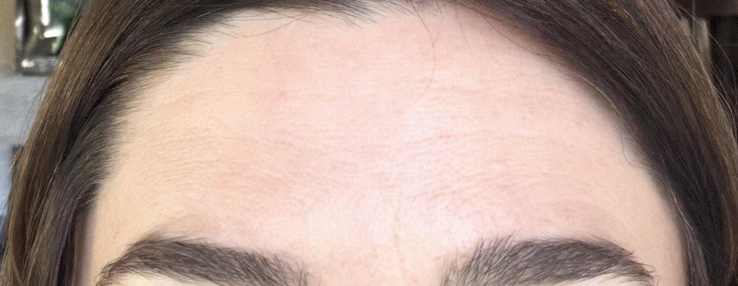 Forehead after neurotoxin treatment