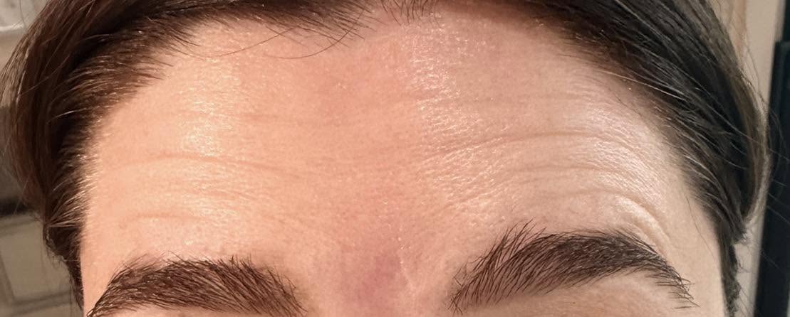 Forehead before neurotoxin treatment