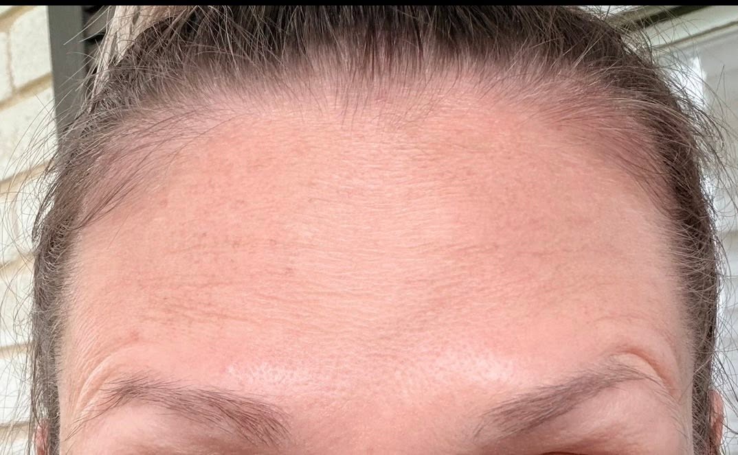 Smooth results after Botox
