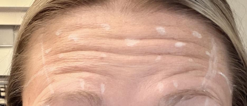 Treatment mapping before Botox
